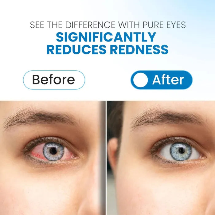 PURE EYES STERILE EYE DROPS 7ML